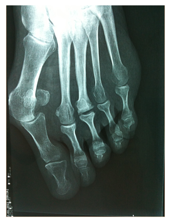 HALLUX VALGUS 