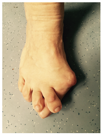 HALLUX VALGUS 