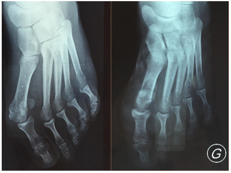 HALLUX VALGUS 