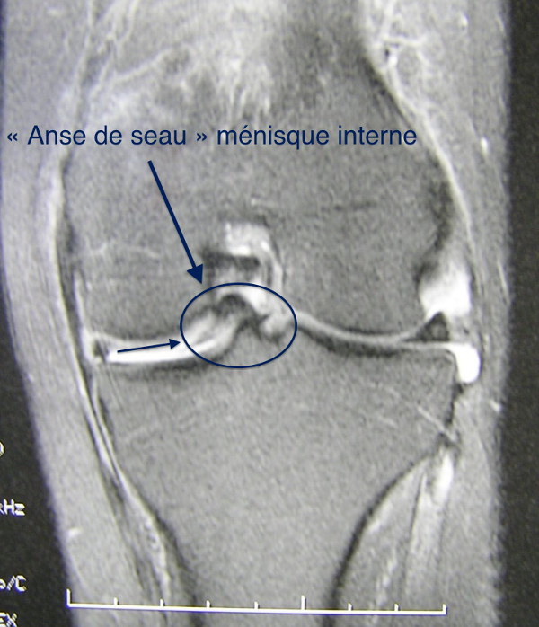 PATHOLOGIE MENISCALE Chirurgie Orthopédique Sainte Marie