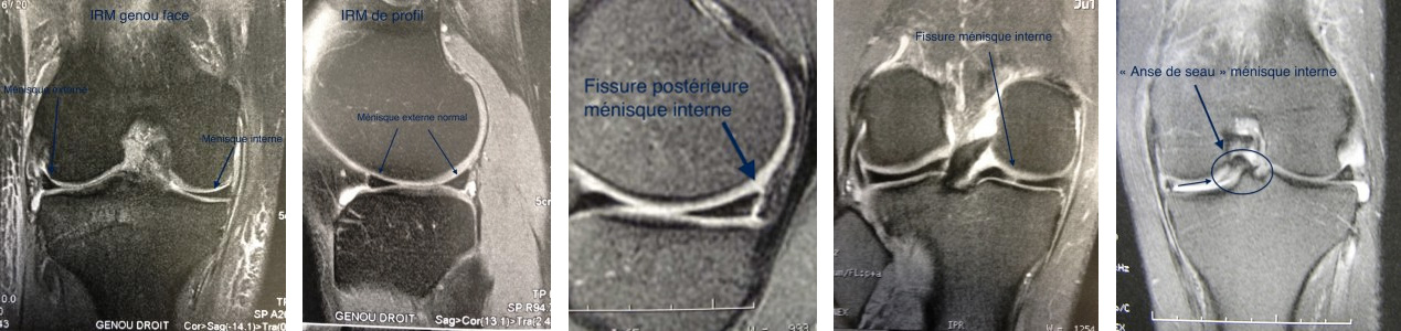 PATHO-MENISC-DIAGNOSTIC-IMG01