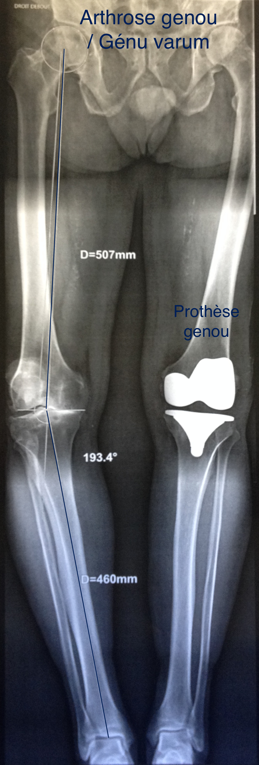 gonarthrose-6-varus-ptg