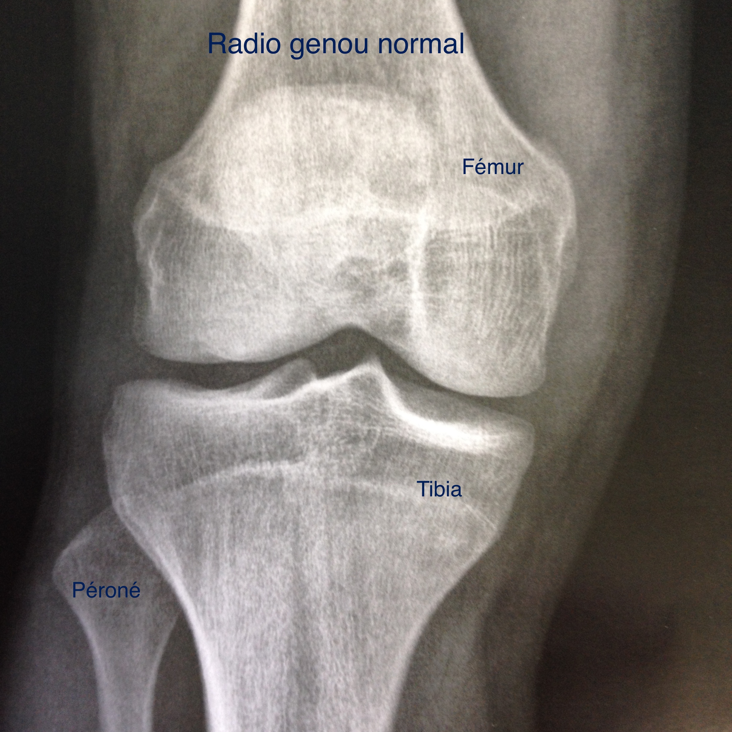 gonarthrose1