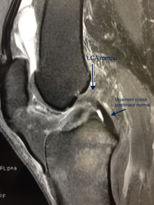 ligament croisé antérieur