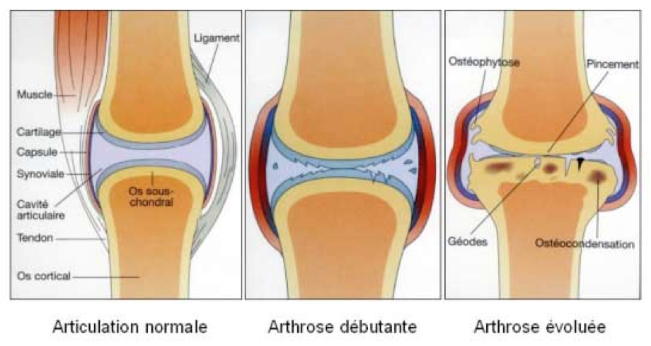 l’arthrose de l’épaule