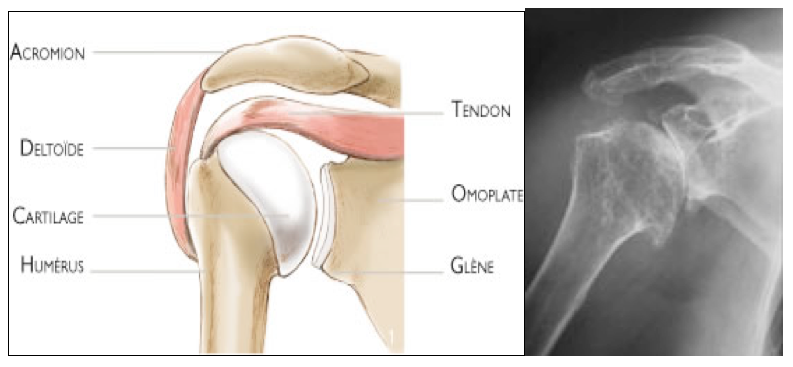 l’arthrose de l’épaule