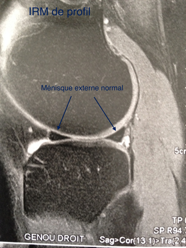 PATHOLOGIE MENISCALE Chirurgie Orthopédique Sainte Marie